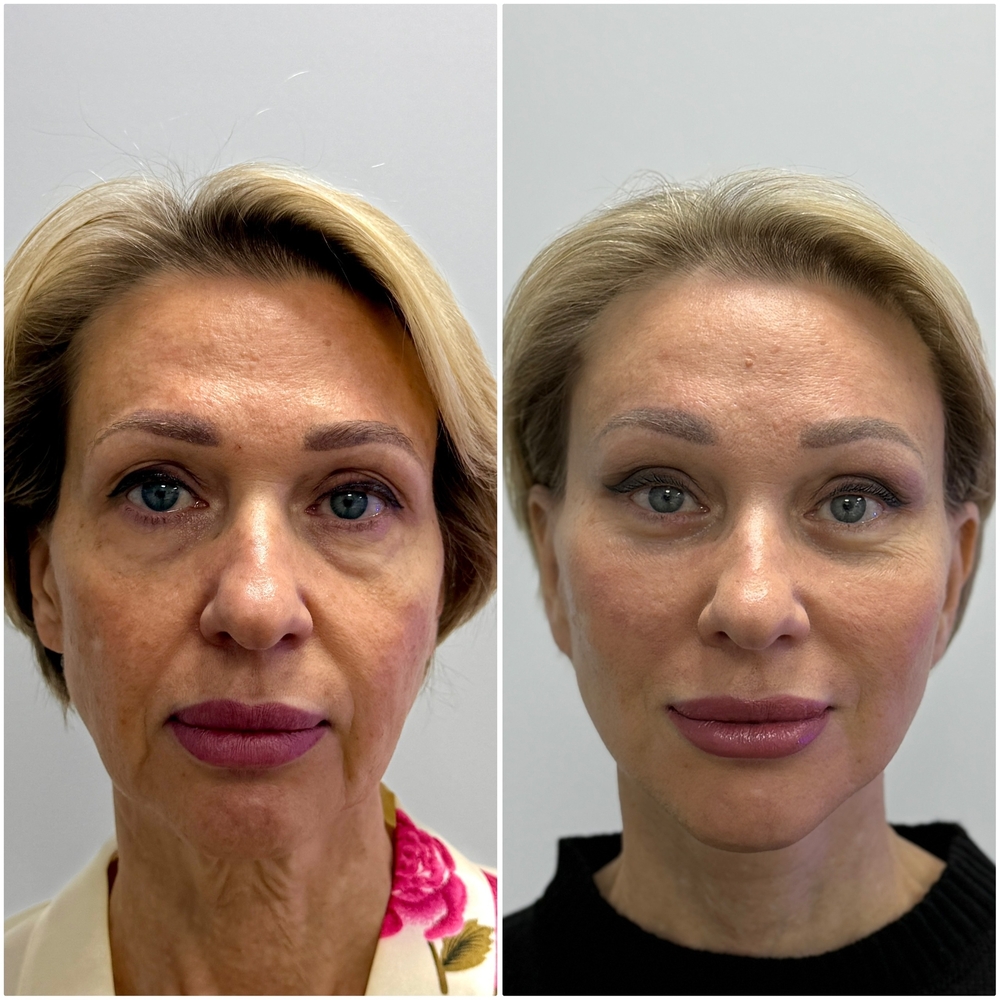 липофилинг лица фото до и после